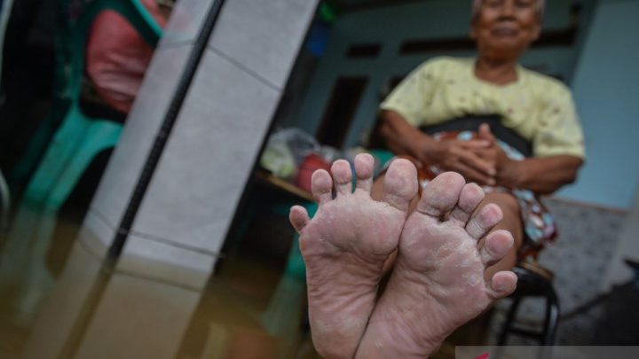 Kaki gatal terus? Kenali 5 penyebab, cara mengatasi dan mencegahnya